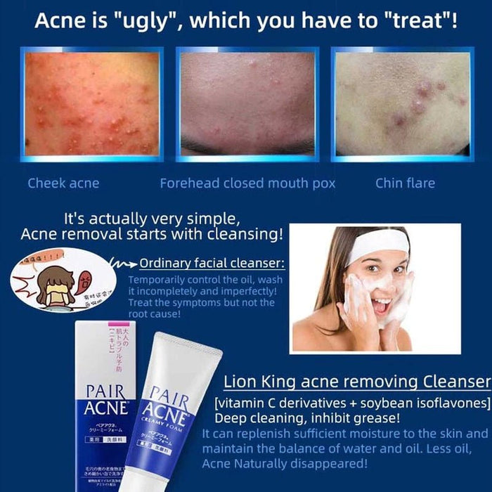 Lion Acne Pair Creamy Foam 80g ليون لعلاج حب الشباب، كريم رغوي مزدوج - Princess Cosmetics Qatar