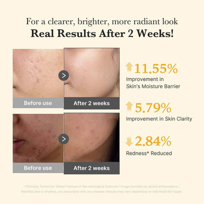 Before and after results of using Medicube Kojic Acid Turmeric Niacinamide Serum 30ml after 2 weeks showing skin improvement.