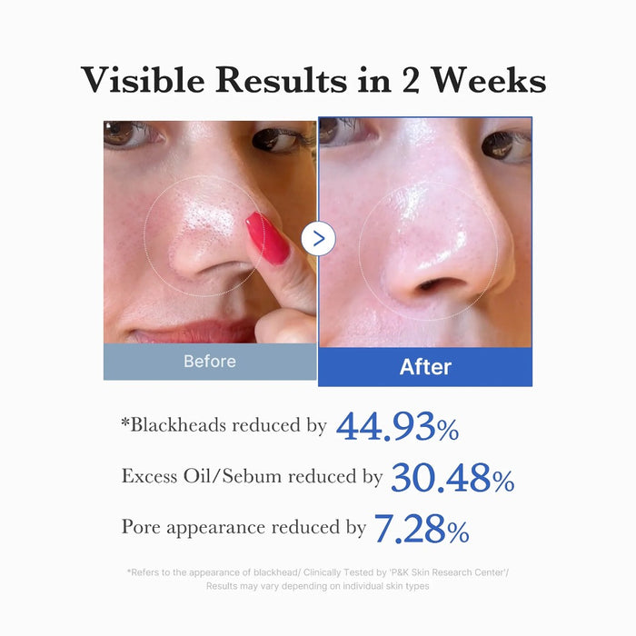 Before and after results of medicube Zero Pore Pad 2.0 showing reduced blackheads, oil, and pore appearance.