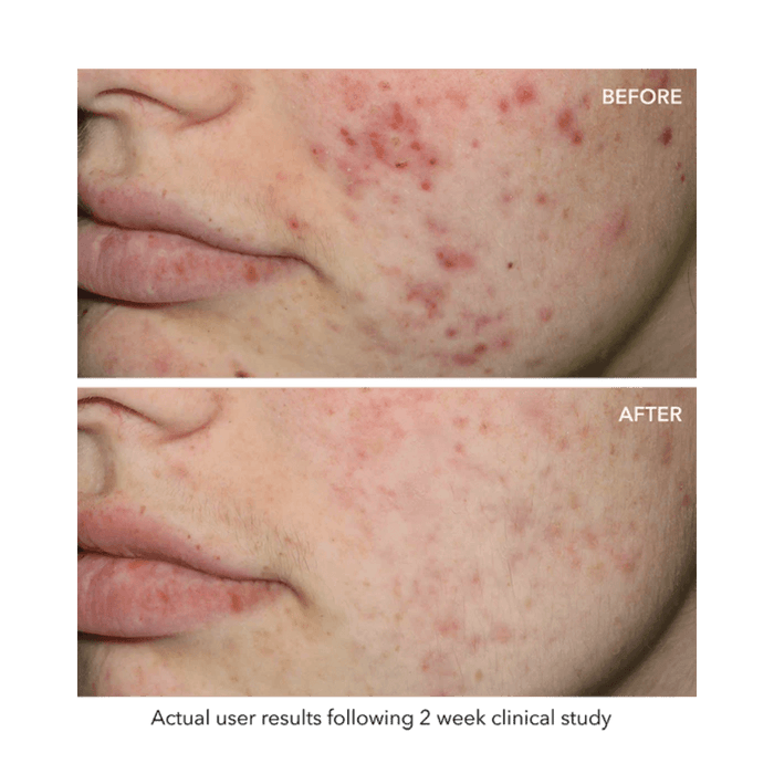 Quasar MD blue light therapy for acne