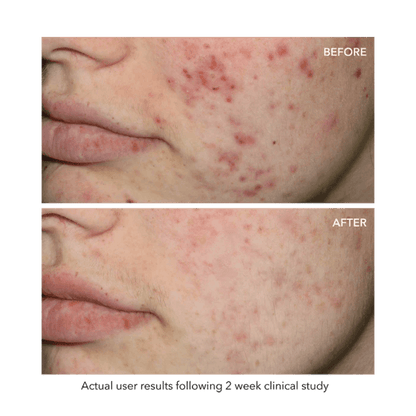 Quasar MD blue light therapy for acne